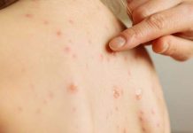 Confirmada primeira morte causada por sarampo neste século no Brasil